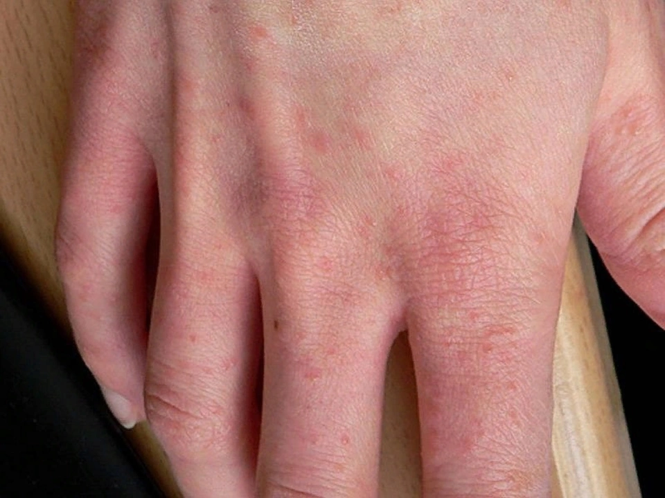 Crotamiton i behandlingen av Dermatitis Herpetiformis